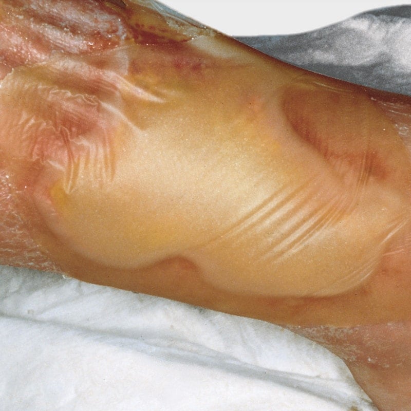 Hydrocoll Hydrocolloid Dressing 5 x 5cm