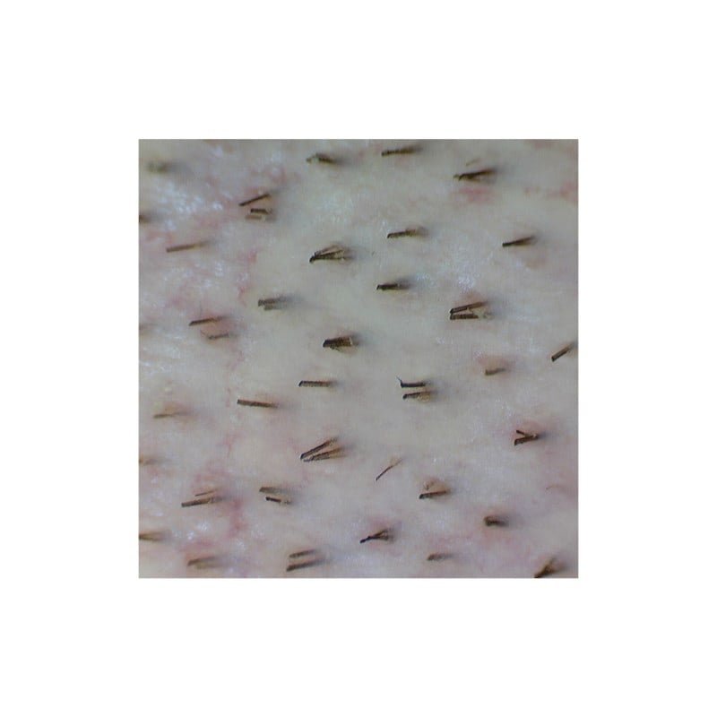 Firefly Video Dermatoscope DE300 (cable data transfer)