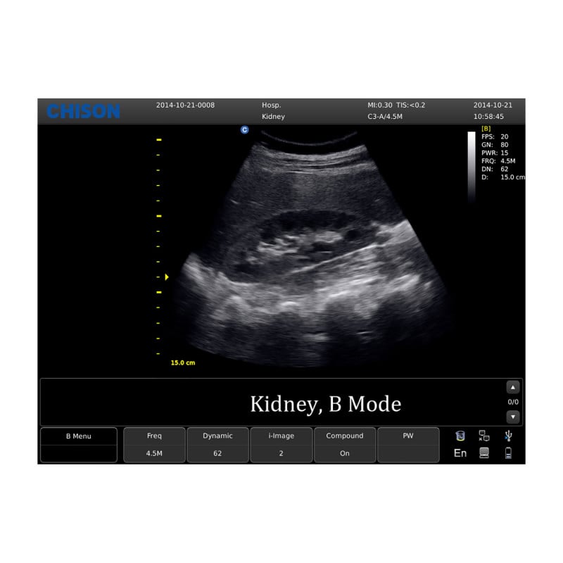 CHISON ECO5 incl. Ultrasound Trolley with convex probe