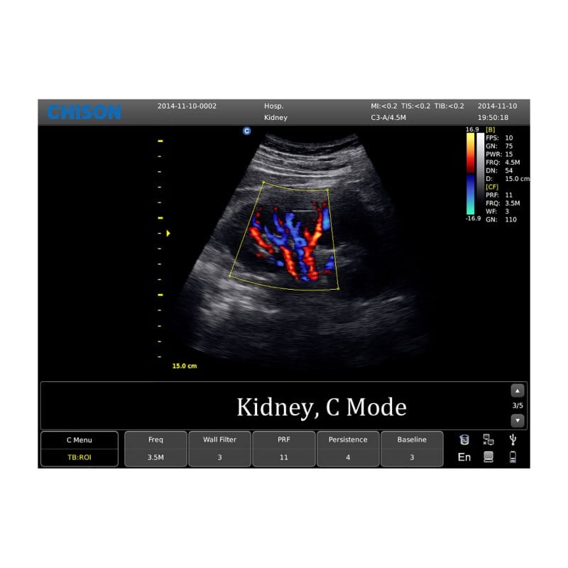 CHISON ECO5 Ultrasound Machine with Color Doppler + convex transducer