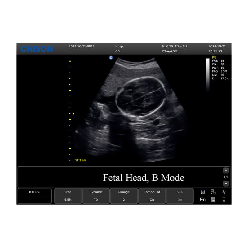CHISON ECO3 Expert Ultrasound Machine with convex transducer (C3-A)