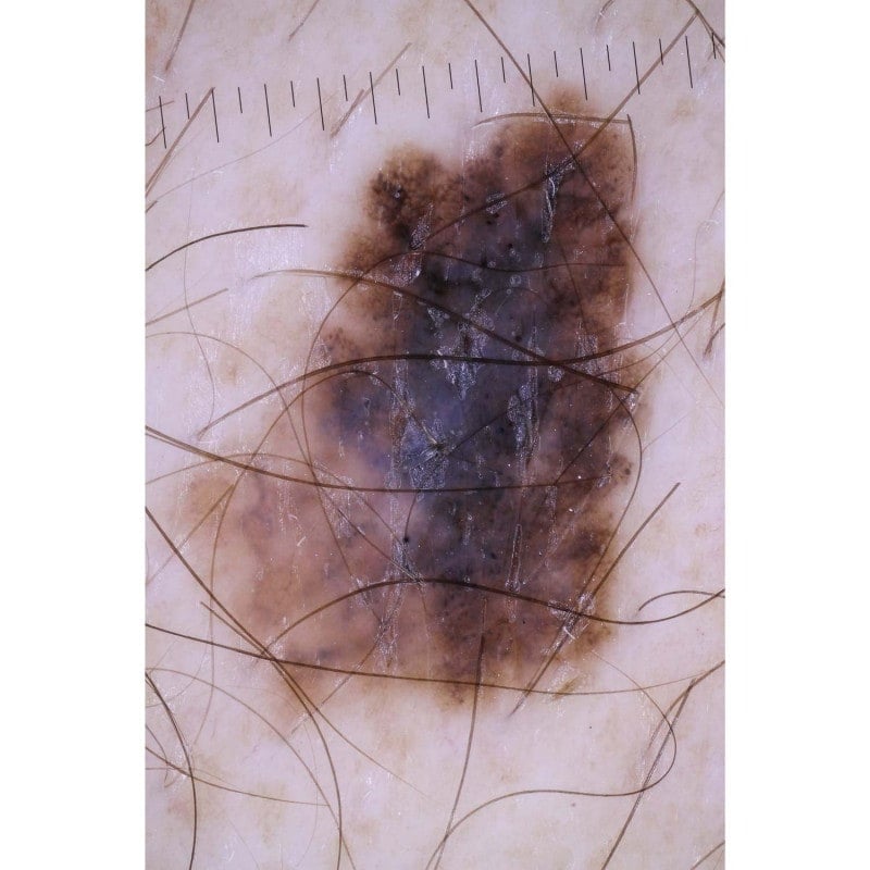 DermLite Foto II Pro