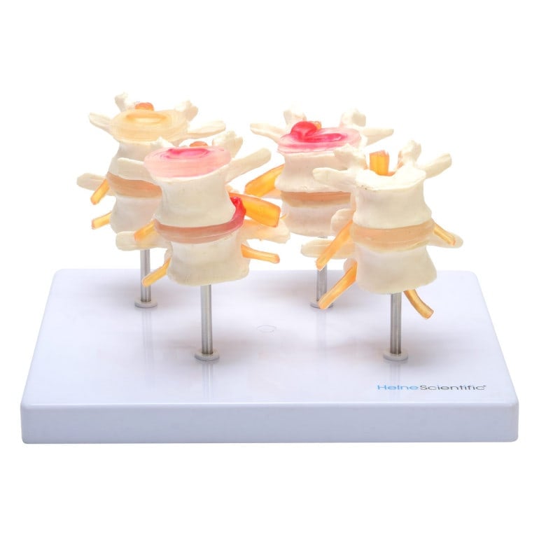 HeineScientific Intervertebral Disc Model