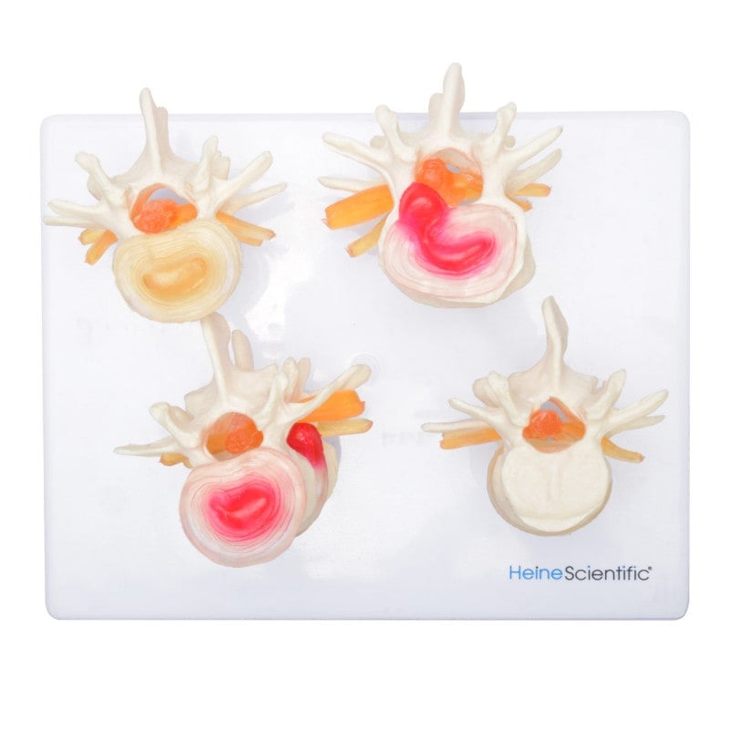 HeineScientific Intervertebral Disc Model