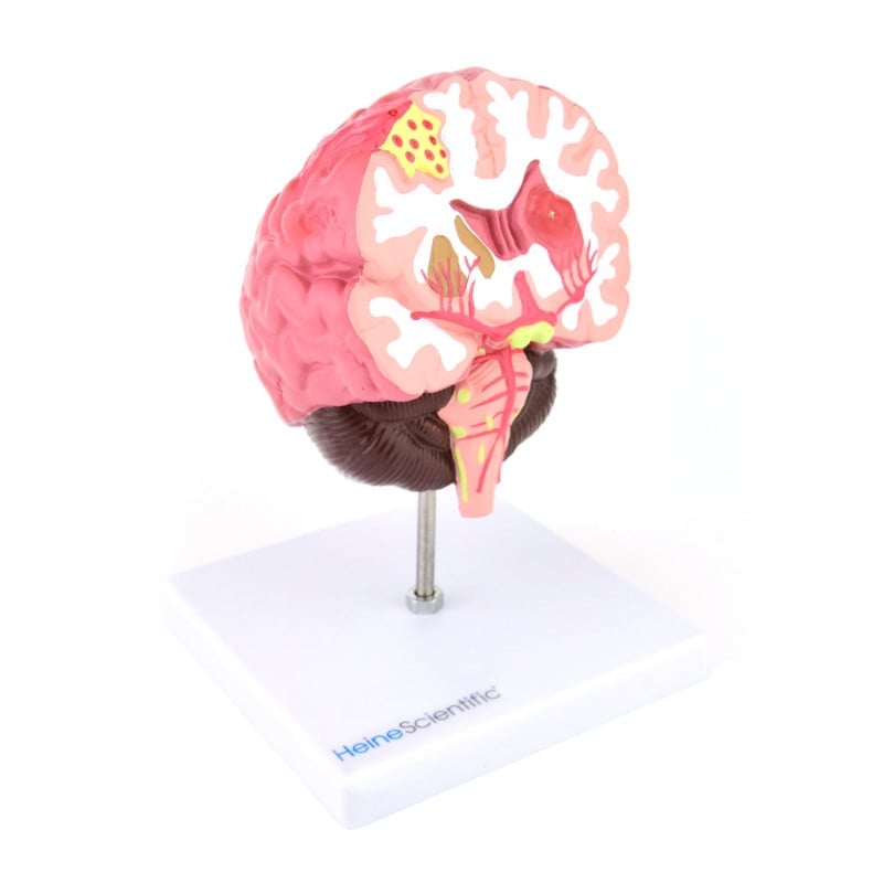 Brain Model with Diseases