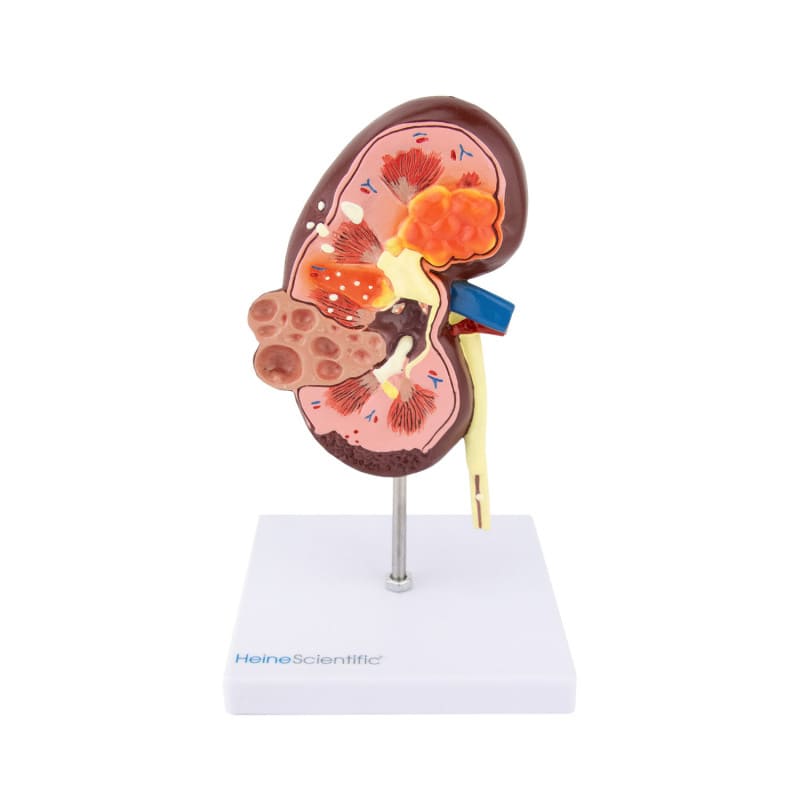 Kidney Model with Diseases