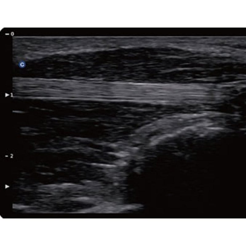 QBit 5 Ultrasound Machine with battery