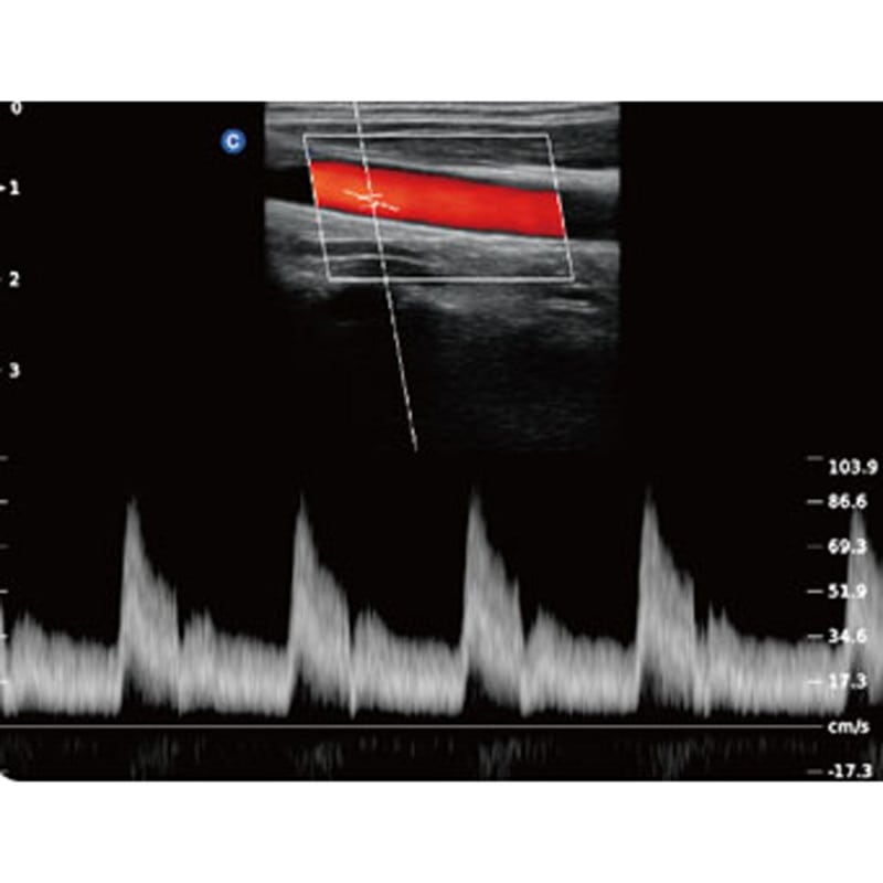 QBit 5 Ultrasound Machine without battery