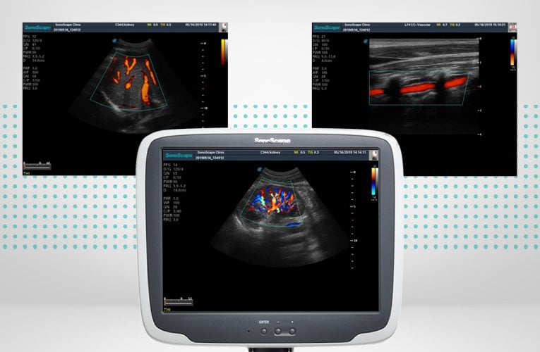 SonoScape S11 Plus ultrasound system battery included