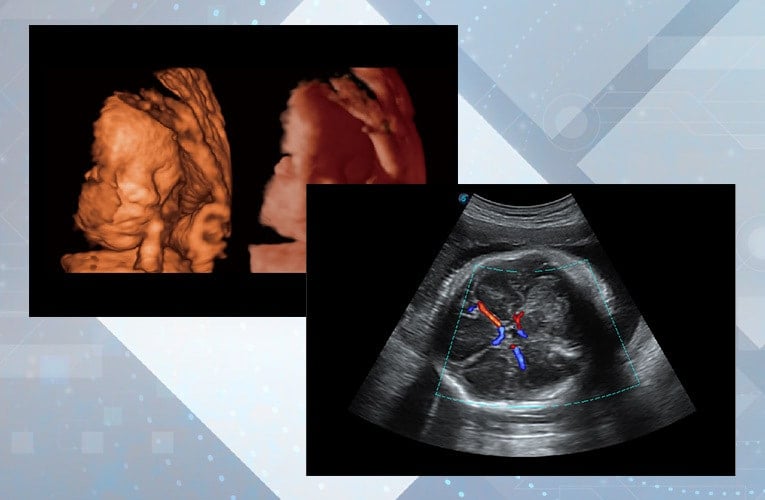 Sonoscape P15 Ultrasound Machine without battery