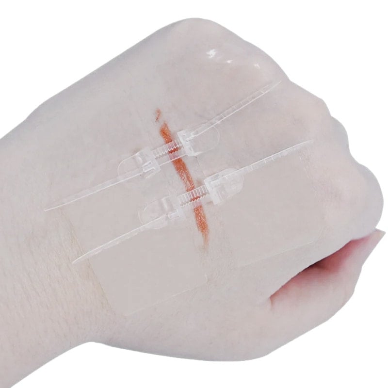 Zip Wound Closure Device G1 6 x 7 cm