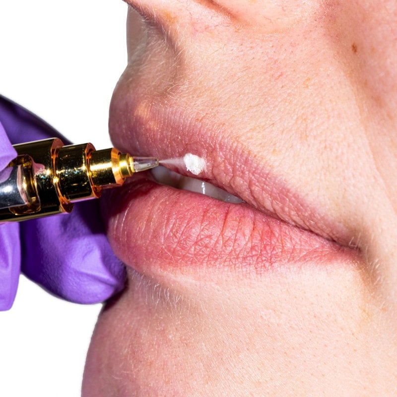 Cryoalfa SUPER Contact | in blister