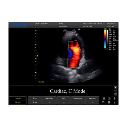 CHISON ECO5 incl. Ultrasound Trolley with convex probe