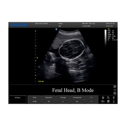 CHISON ECO3 Expert Ultrasound Machine with linear transducer (L7M-A)
