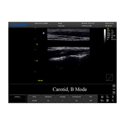 Chison ECO 1 Ultrasound Machine with rechargeable battery | linear transducer (L7M-A)