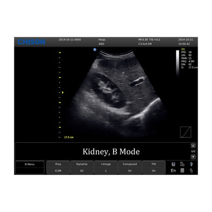 Chison ECO 1 Ultrasound Machine with rechargeable battery | linear transducer (L7M-A)