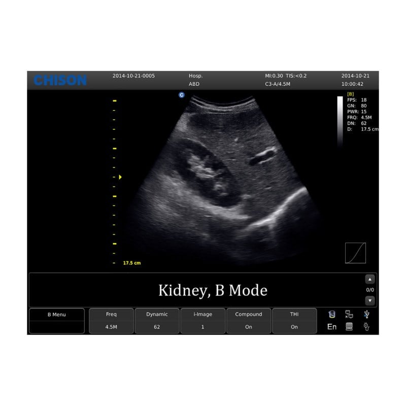 Chison ECO 1 Ultrasound Machine with rechargeable battery | convex transducer (C3-A)