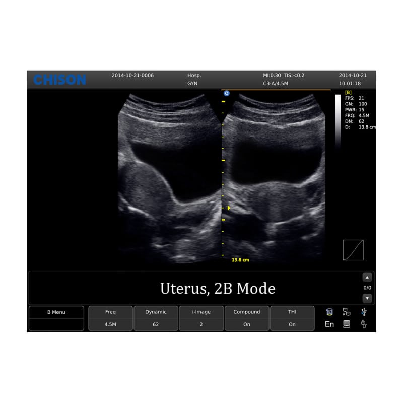 Chison ECO 1 Ultrasound Machine without rechargeable battery | convex transducer (C3-A)