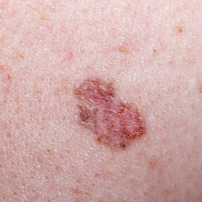 LuxaScope CCT Dermatoscope without scaling