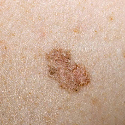 LuxaScope CCT Dermatoscope without scaling