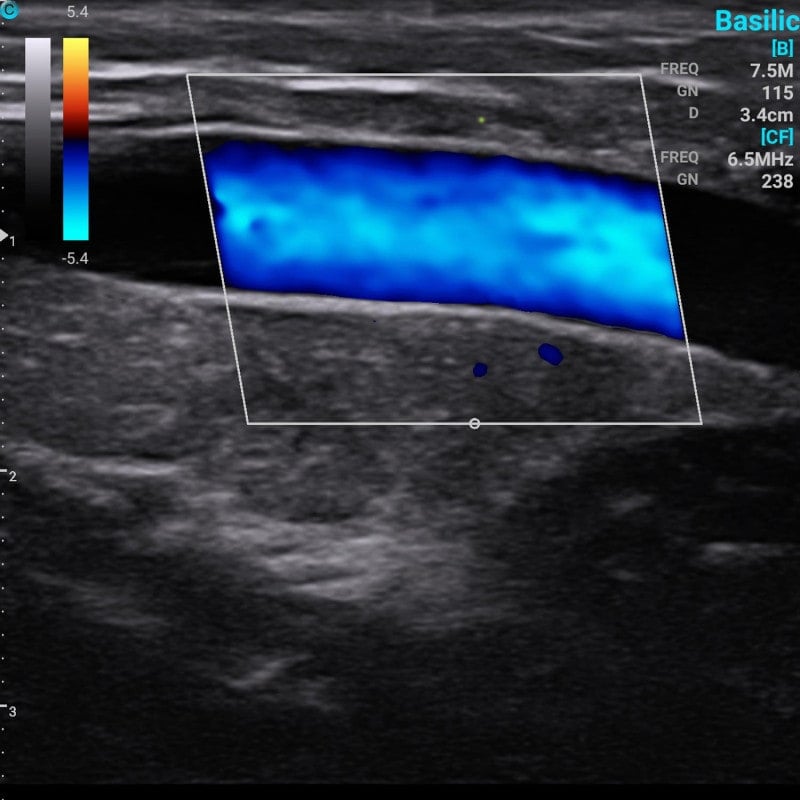 Chison Portable Ultrasound Machine “SonoEye” P6 (with 6.0 MHz micro-convex probe)