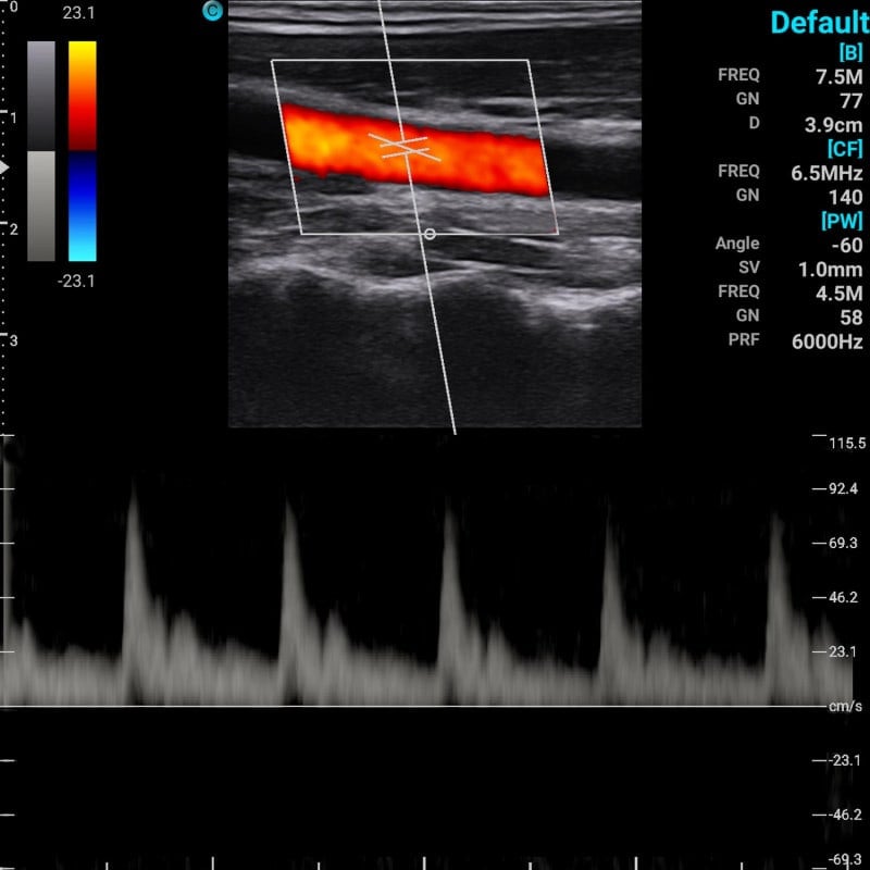 Chison Portable Ultrasound Machine “SonoEye” P2 (with 7.5 MHz linear transducer)