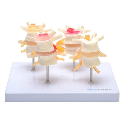 HeineScientific Intervertebral Disc Model