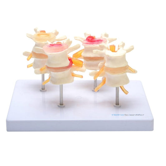 HeineScientific Intervertebral Disc Model