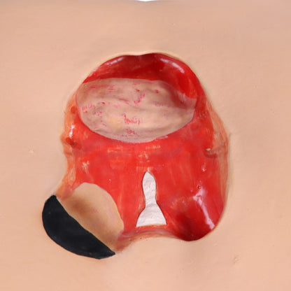 DECUBITUS DAN Treatment Simulator