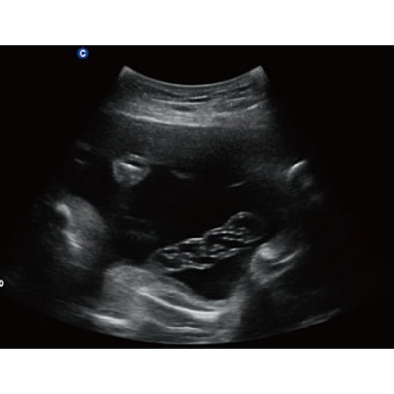 QBit 5 Ultrasound Machine with battery